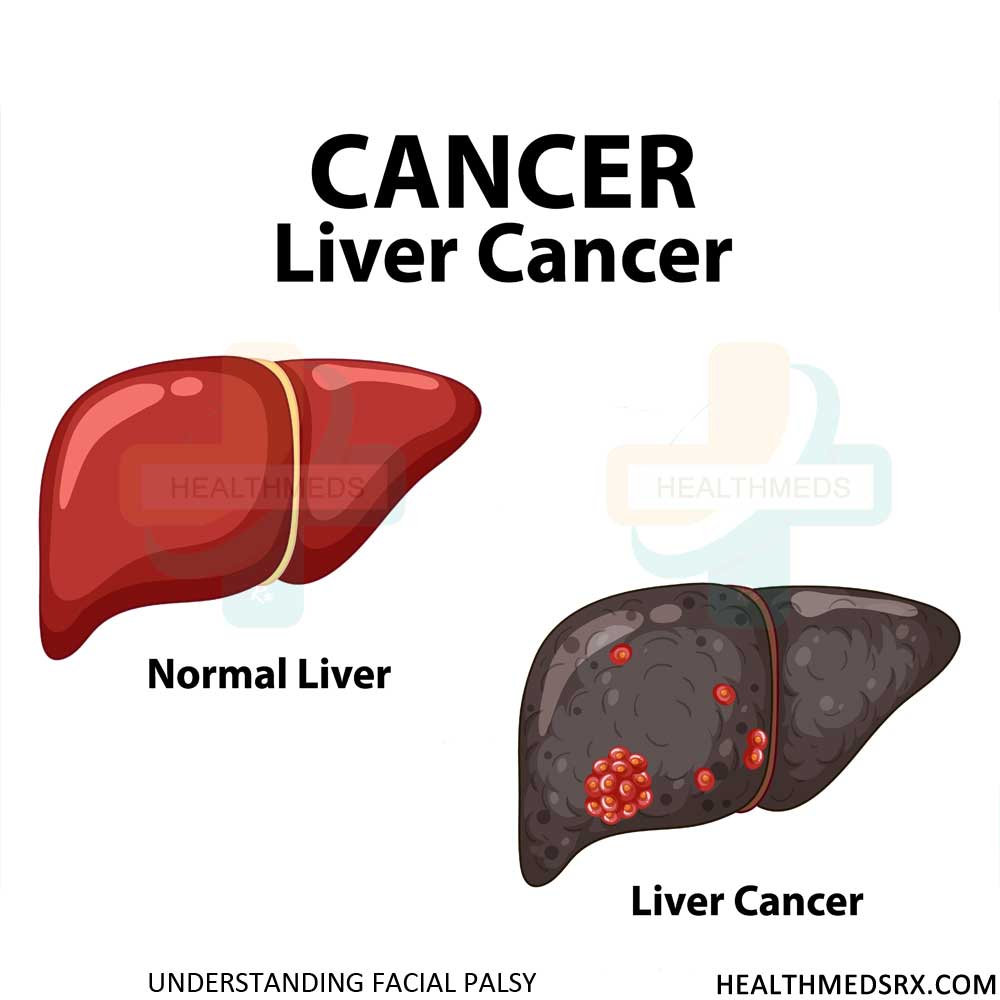 Liver Cancer