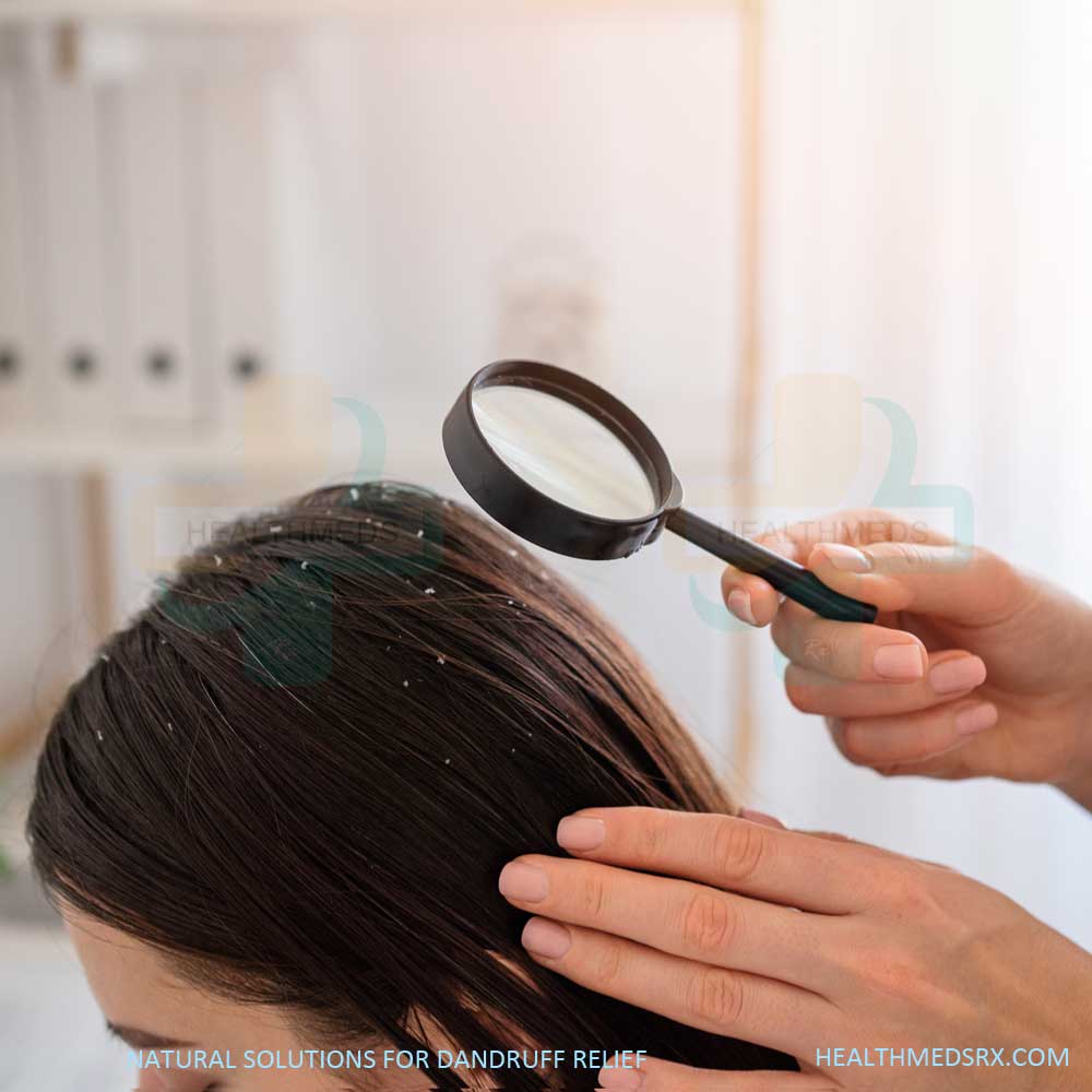 Natural Solutions for Dandruff Relief