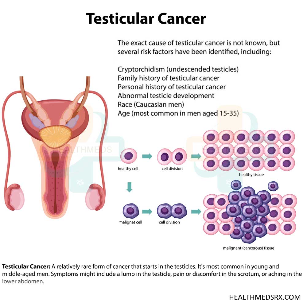 Testicular Cancer