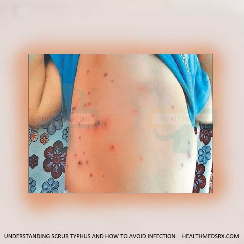 Scrub Typhus Infection