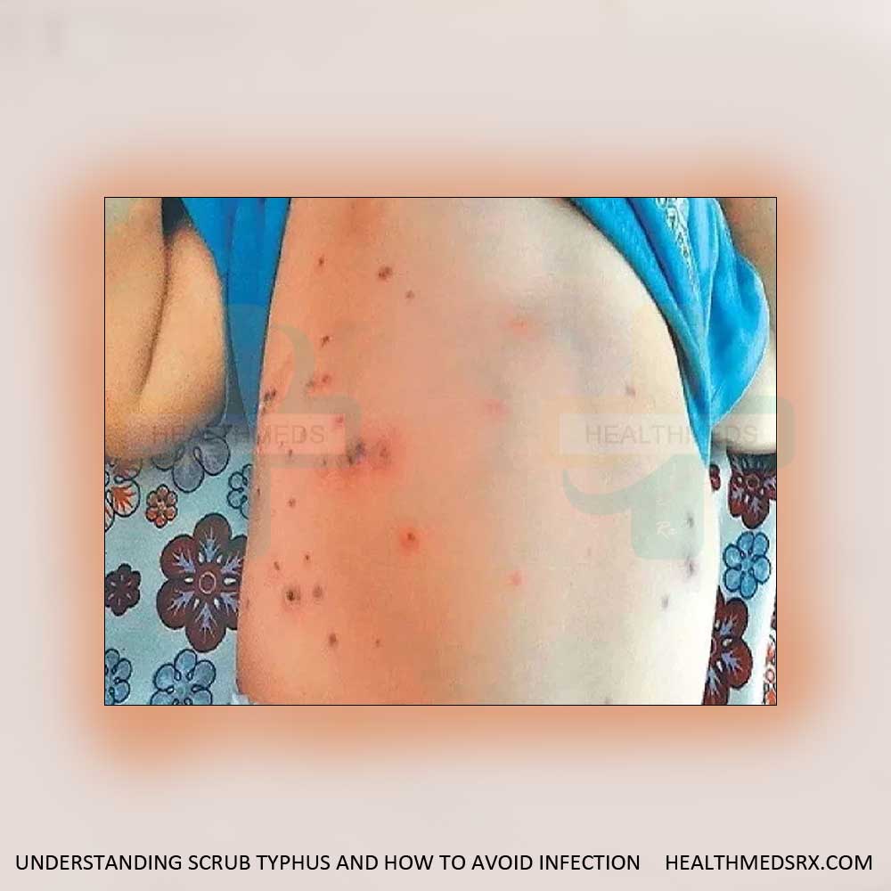 Scrub Typhus Infection